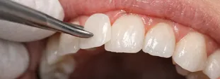 Porcelain Veneers (Lamina Veneers) in Istanbul