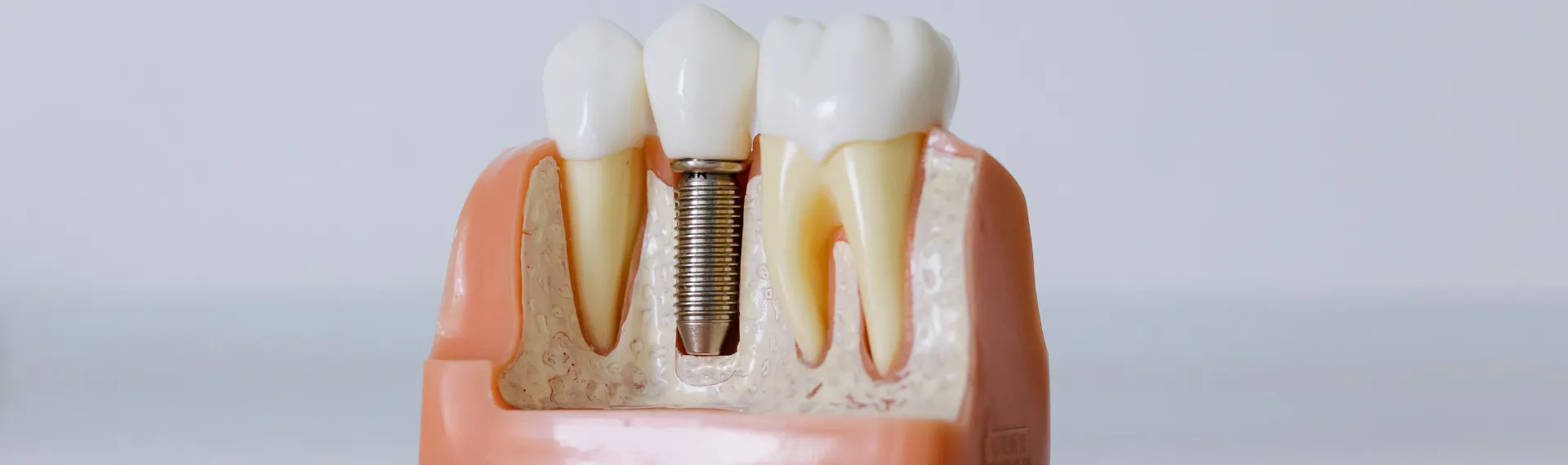 Implant-Supported Prostheses in Istanbul