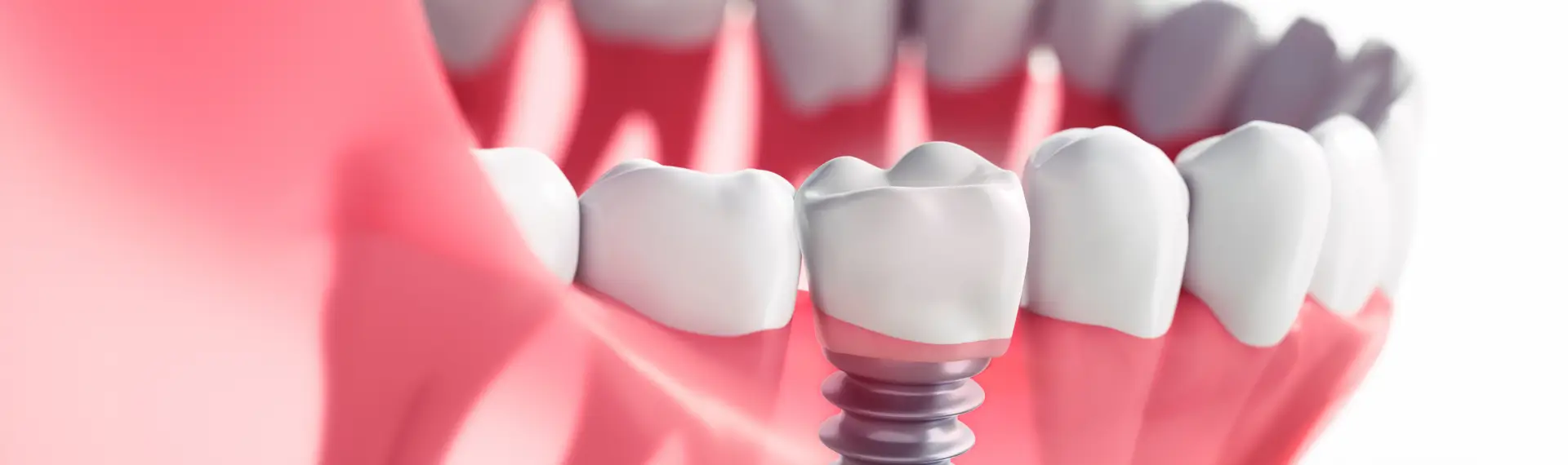 Kemik Grefti ve Sinüs Lift